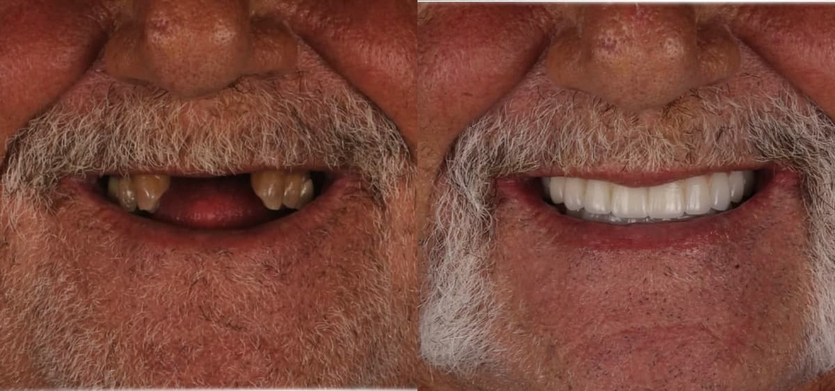 Full Mouth Rehabilitation — Clinical Dental Care at Dant काया Multispeciality Clinic, Patna
