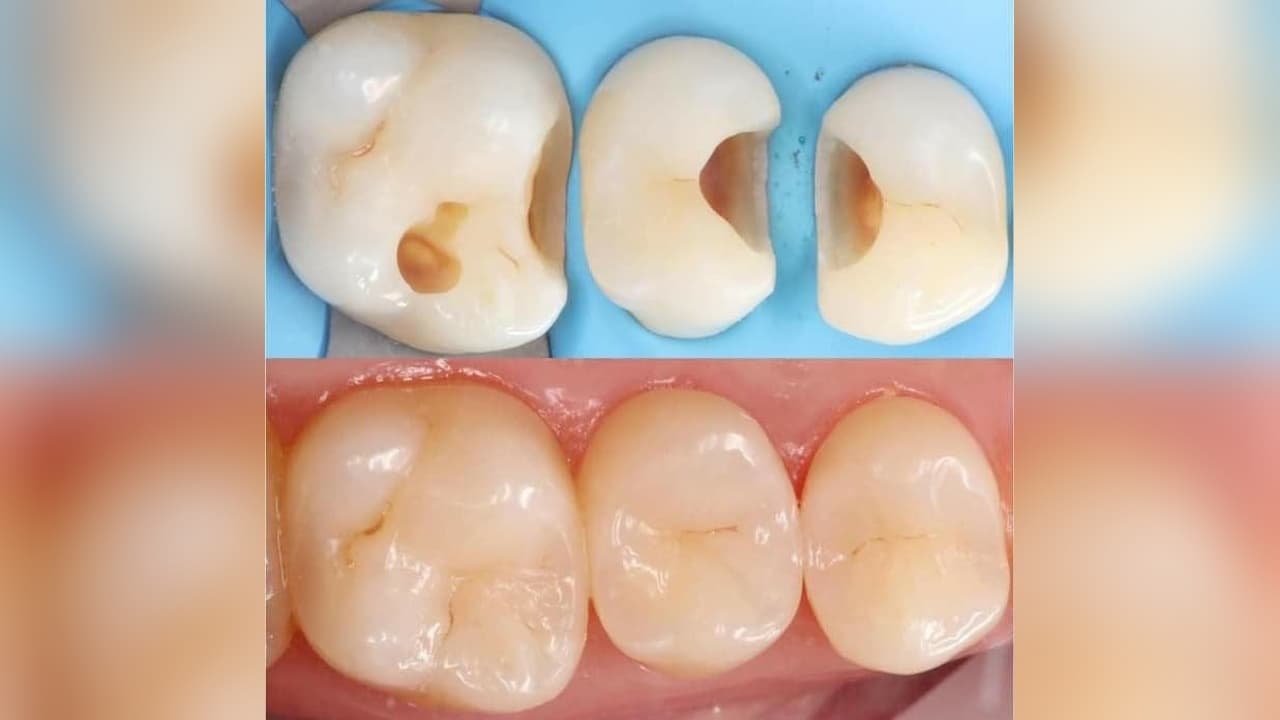 Cosmetic Filling & Restoration of Dental Caries — Clinical Dental Care at Dant काया Multispeciality Clinic, Patna