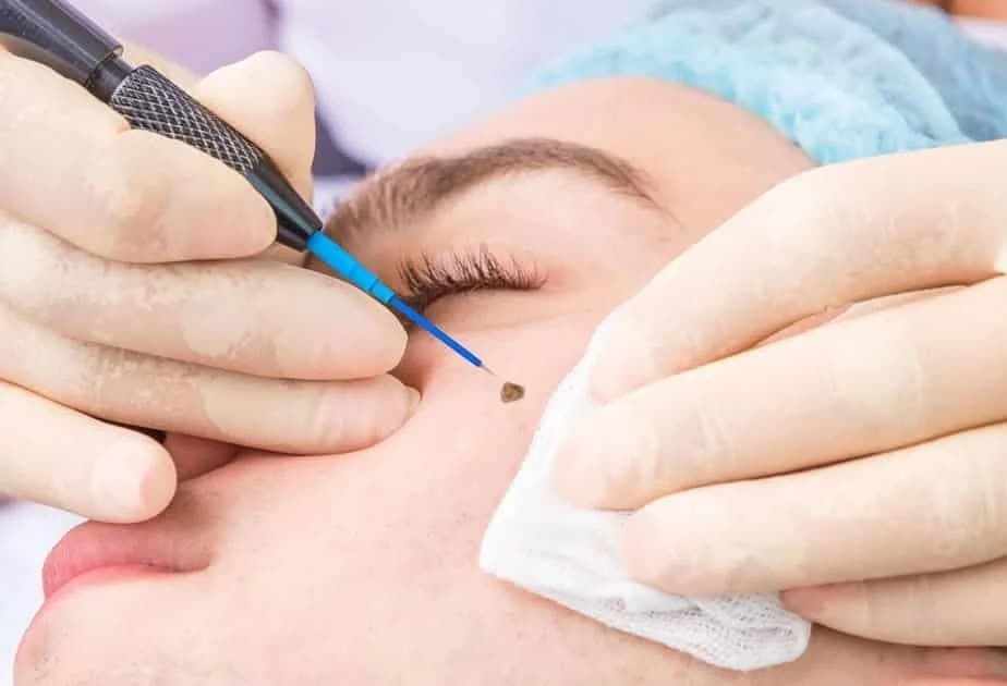 Mole / Wart Removal — Clinical Skin & Facial Aesthetics at Dant काया Multispeciality Clinic, Patna